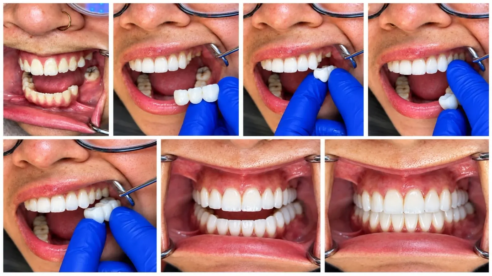 Secuencia clínica de la colocación de un puente dental, desde el diente ausente hasta la restauración final