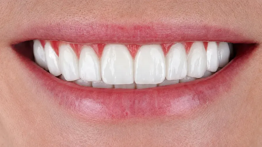 Real patient case 3 of All-on-4 implants — after