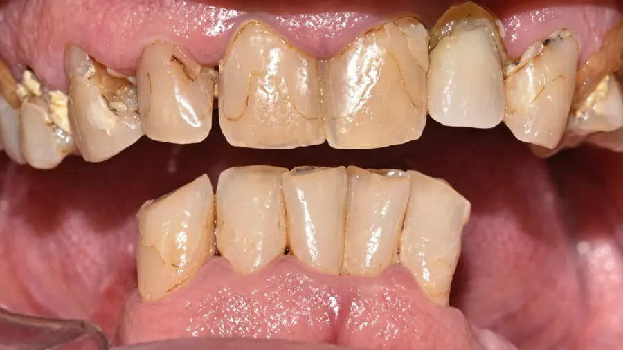 Real patient case 5 of All-on-4 implants — before
