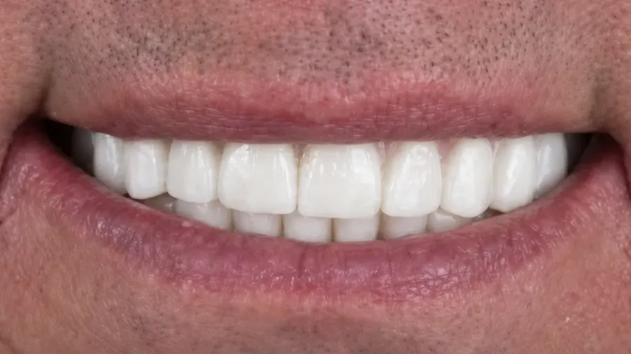 Real patient case 7 of All-on-4 implants — after