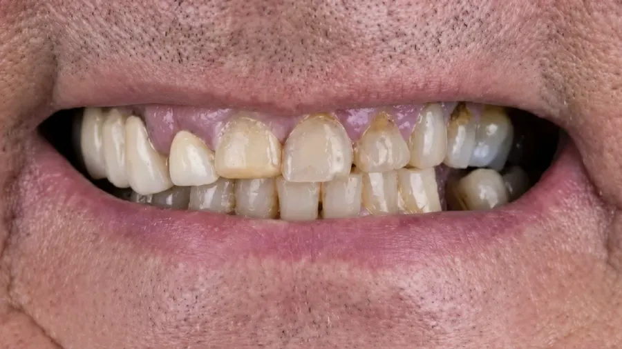 Real patient case 7 of All-on-4 implants — before