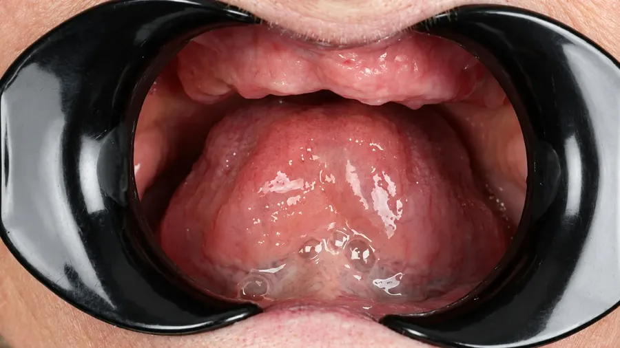 Real patient case 8 of All-on-4 implants — before
