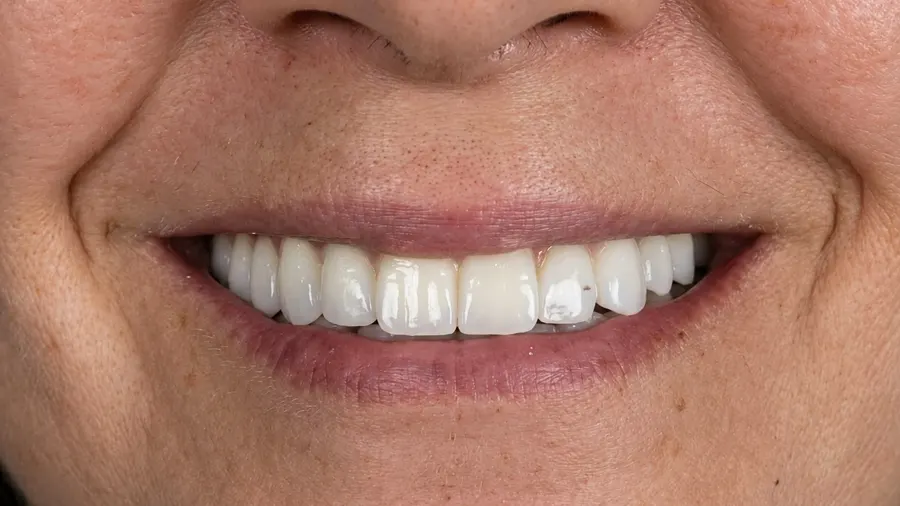 Real patient case 9 of All-on-4 implants — after