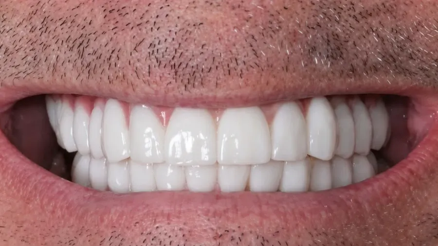 Real patient case 12 of All-on-4 implants — after