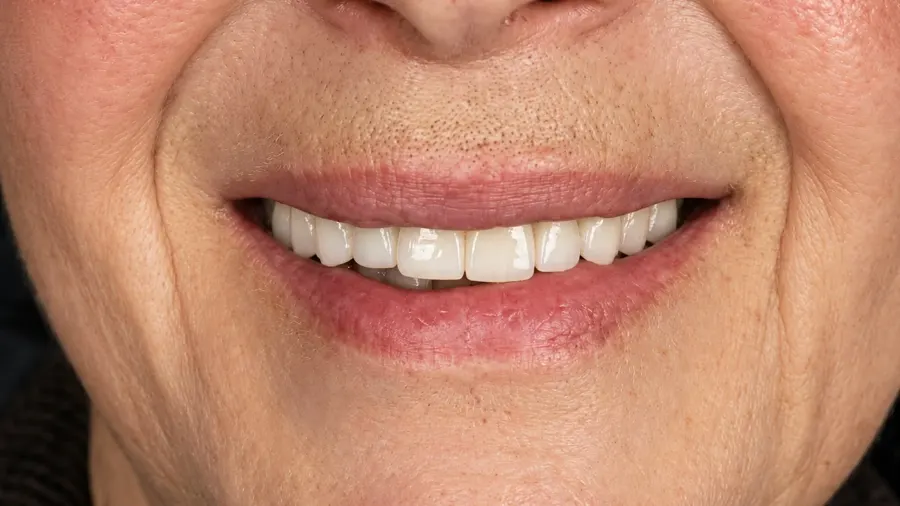 Real patient case 13 of All-on-4 implants — after