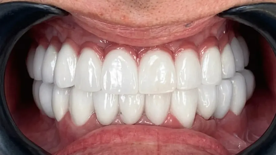 Real patient case 16 of All-on-4 implants — after