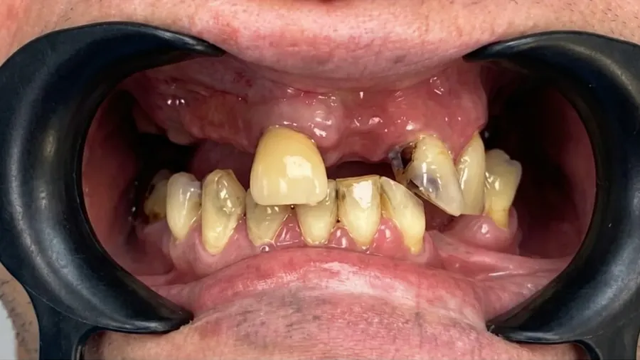 Real patient case 16 of All-on-4 implants — before