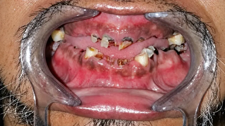 Real patient case 18 of All-on-4 implants — before