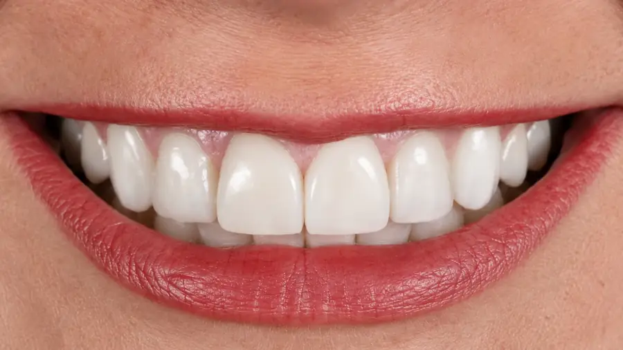 Before and after a smile makeover at Esthetic Dent — after
