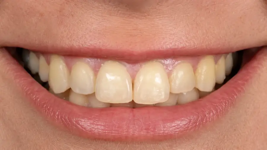 Before and after a smile makeover at Esthetic Dent — before
