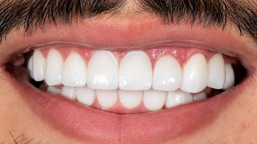 Real patient case 7 of smile makeover — after