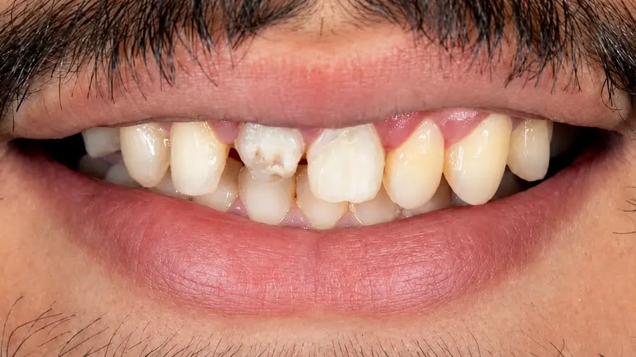 Real patient case 7 of smile makeover — before