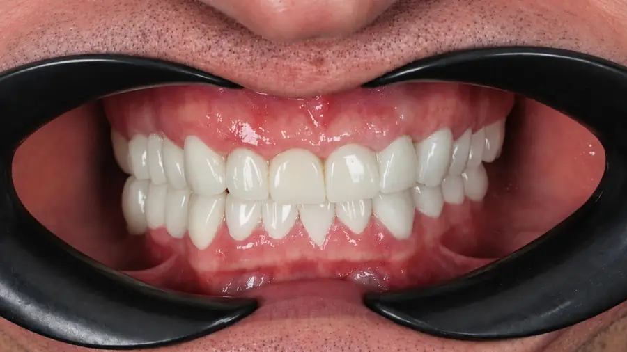 Real patient case 9 of smile makeover — after