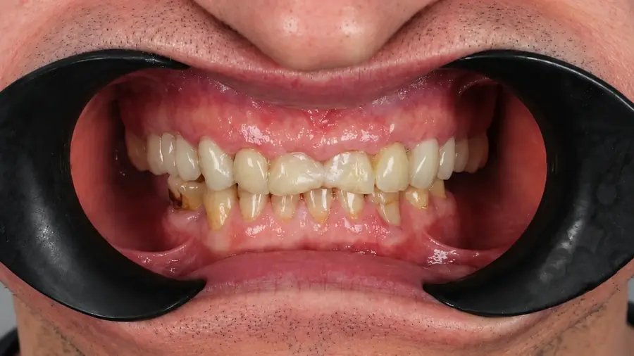 Real patient case 9 of smile makeover — before