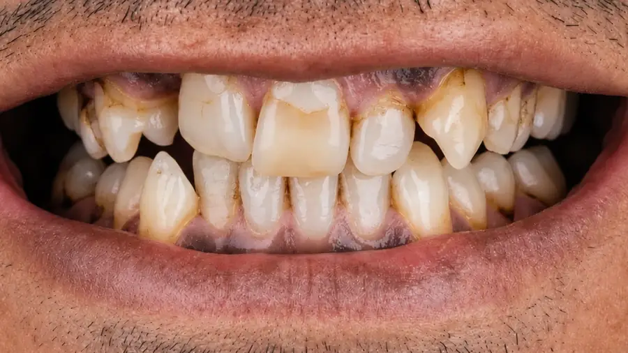 Real patient case 11 of smile makeover — before