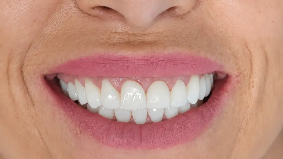 Real patient case 12 of smile makeover — after