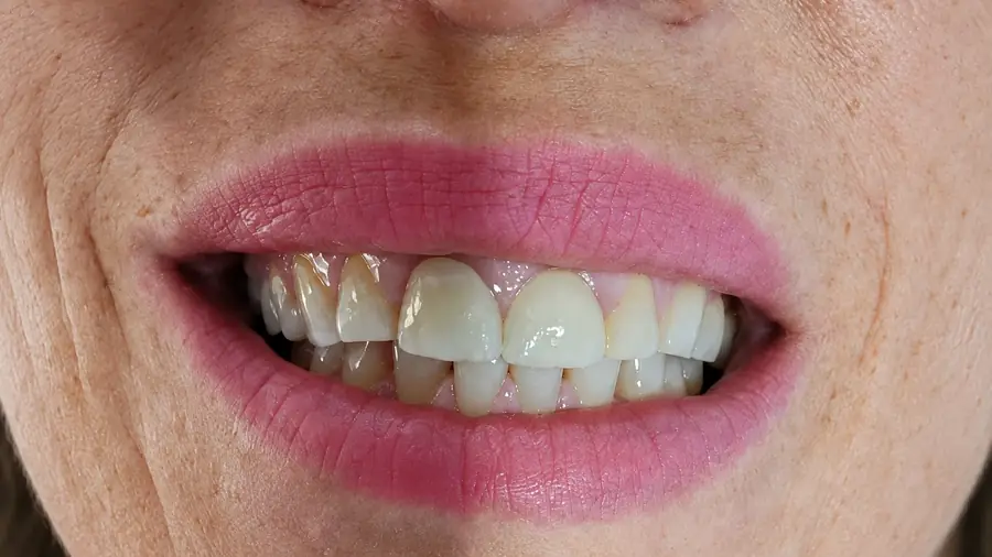 Real patient case 12 of smile makeover — before