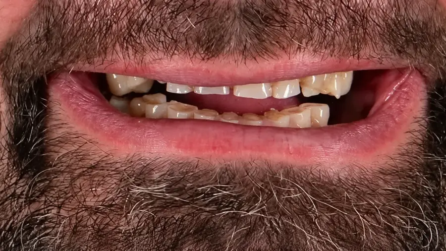 Real patient case 14 of smile makeover — before