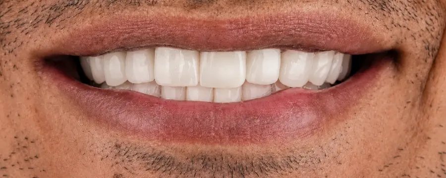 E.max crown at Esthetic Dent in Costa Rica — after