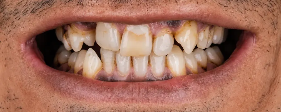 E.max crown at Esthetic Dent in Costa Rica — before