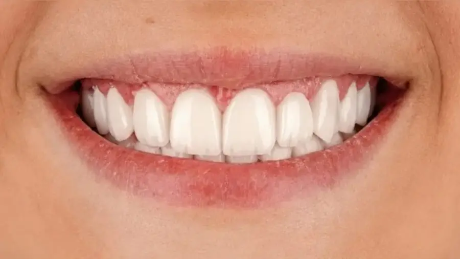 Before and after porcelain veneers at Esthetic Dent in Costa Rica — after