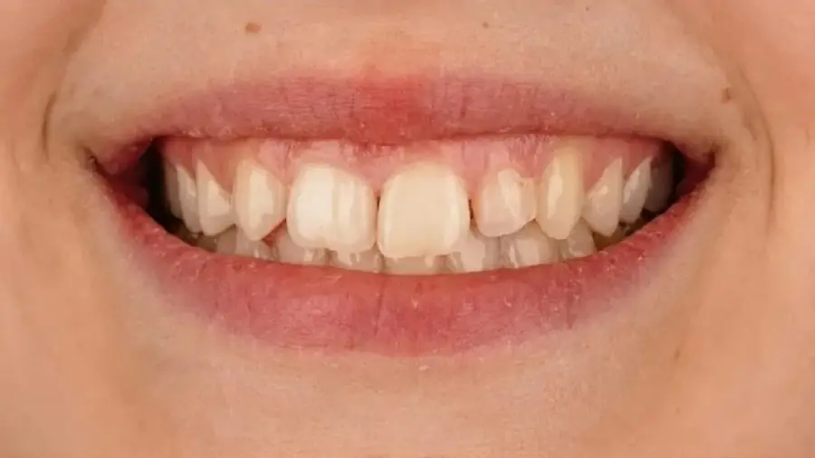 Before and after porcelain veneers at Esthetic Dent in Costa Rica — before