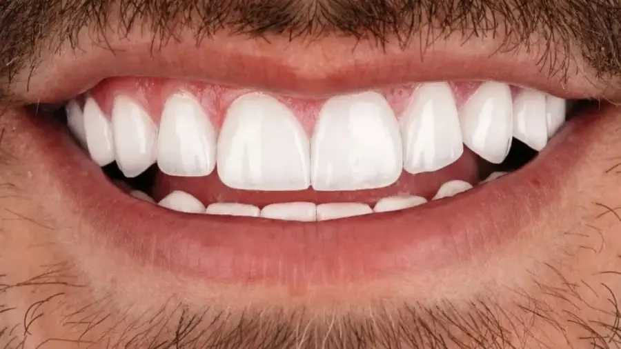 Real patient case 2 of porcelain veneers — after
