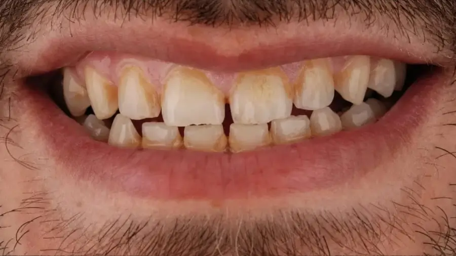 Real patient case 2 of porcelain veneers — before