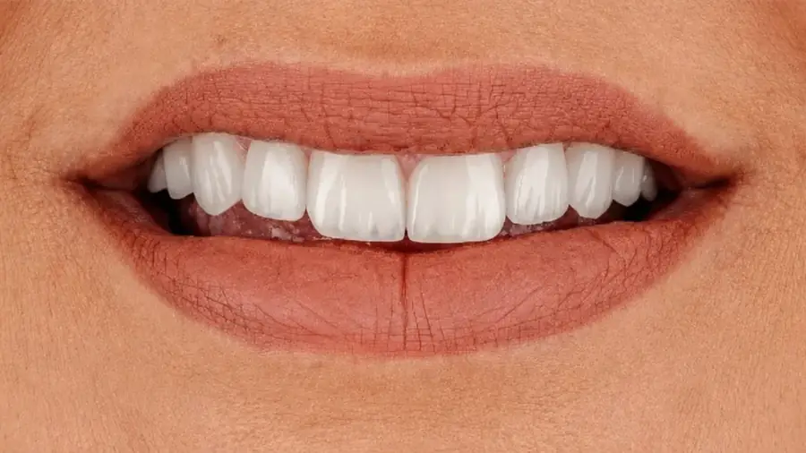 Before and after porcelain veneers at Esthetic Dent — after