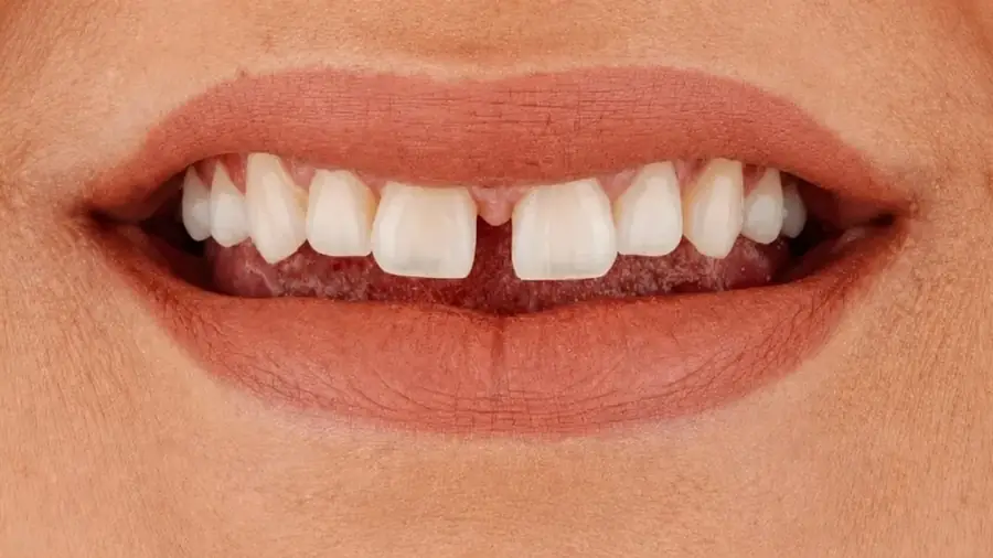 Before and after porcelain veneers at Esthetic Dent — before