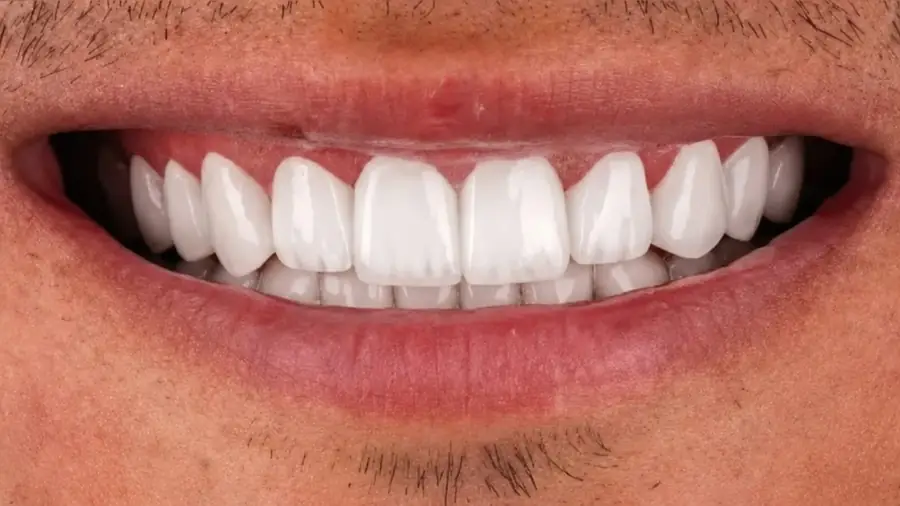 Real patient case 4 of porcelain veneers — after