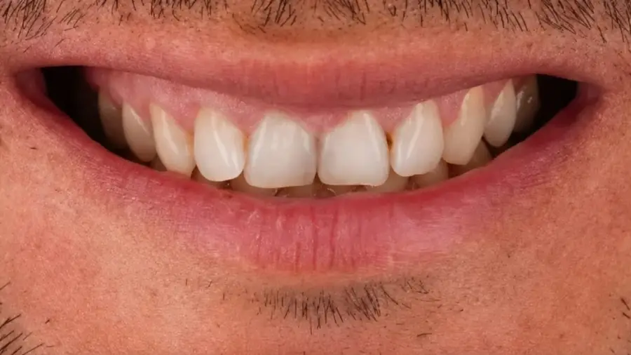 Real patient case 4 of porcelain veneers — before