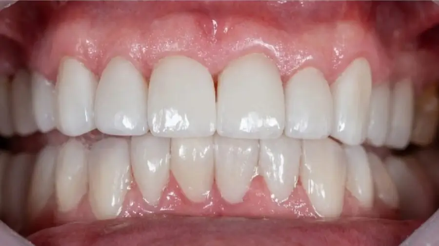 Real patient case 5 of porcelain veneers — after