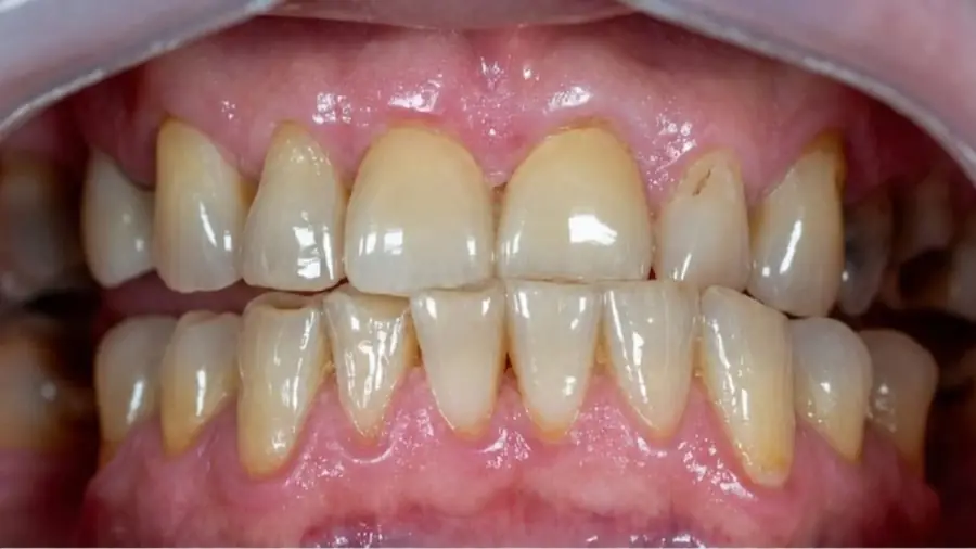 Real patient case 5 of porcelain veneers — before