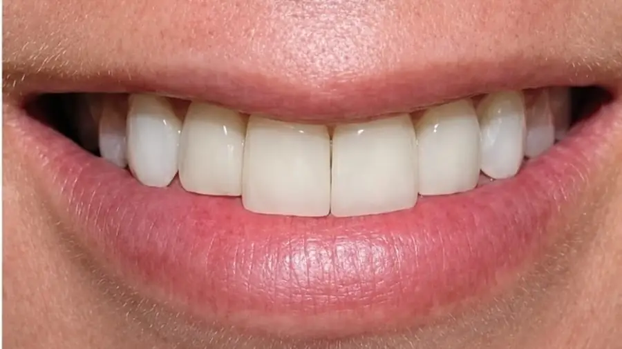 Real patient case 6 of porcelain veneers — after