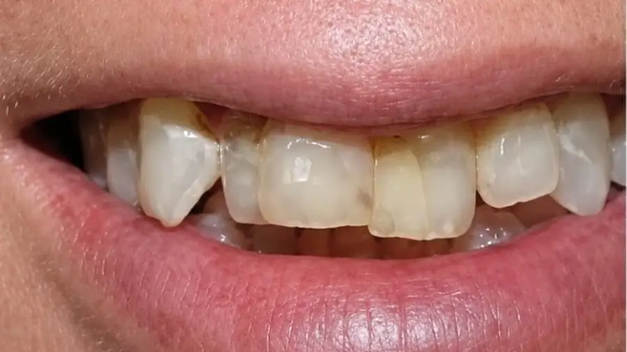 Real patient case 6 of porcelain veneers — before