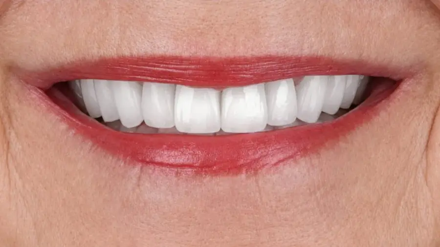Real patient case 9 of porcelain veneers — after