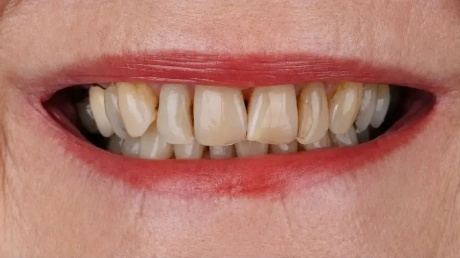 Real patient case 9 of porcelain veneers — before