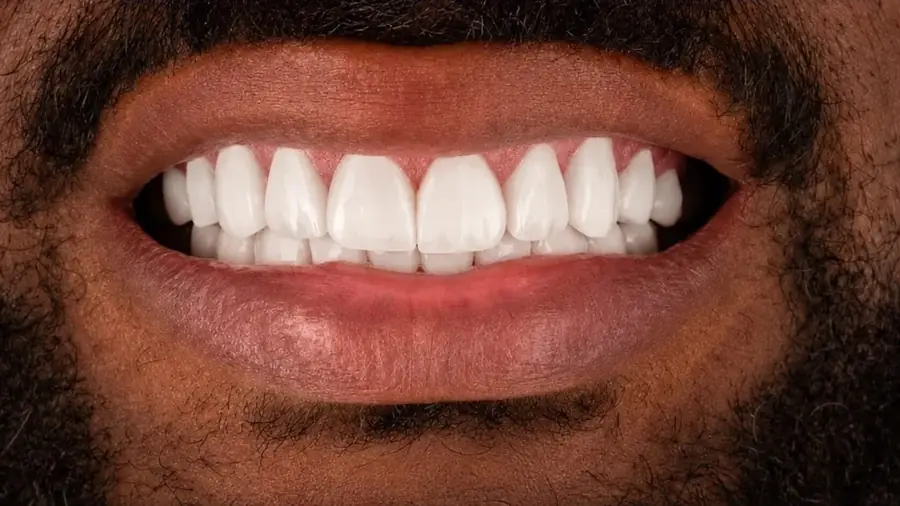 Real patient case 10 of porcelain veneers — after