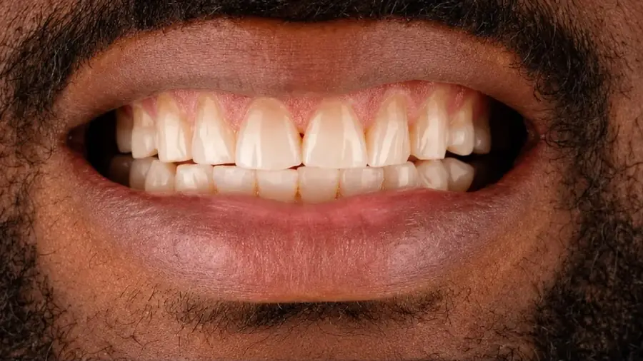 Real patient case 10 of porcelain veneers — before