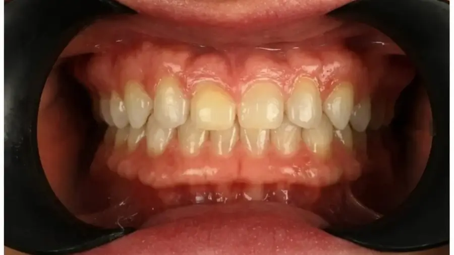 Real patient case 12 of porcelain veneers — before