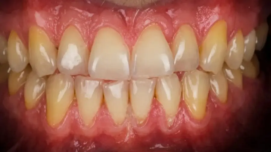 Real patient case 13 of porcelain veneers — before