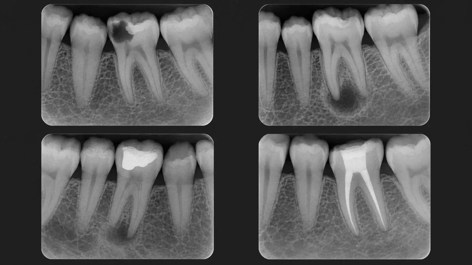 Radiografías digitales que muestran las etapas de un tratamiento de endodoncia, desde la caries hasta el conducto sellado