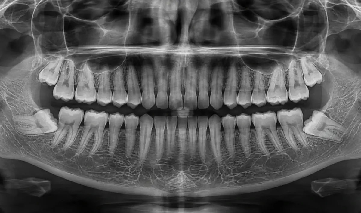 Radiografía panorámica mostrando la posición de las cordales