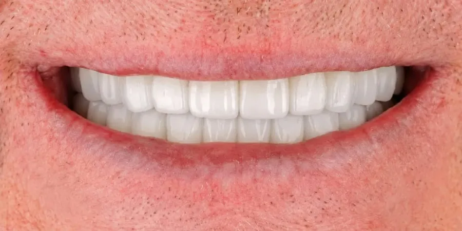 Before and after All-on-4 dental implants at Esthetic Dent in Costa Rica — after