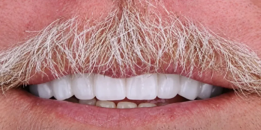 Before and after a full-mouth restoration at Esthetic Dent in Costa Rica — after