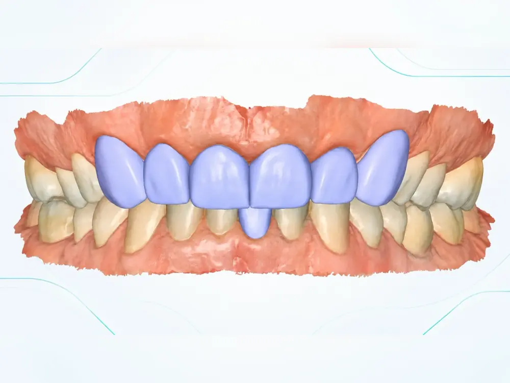 3D digital crown design over the patient's scanned teeth