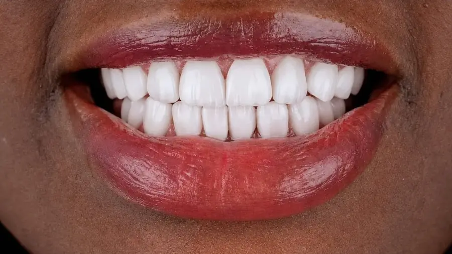 Before and after layered ceramic veneers at Esthetic Dent in Costa Rica — after