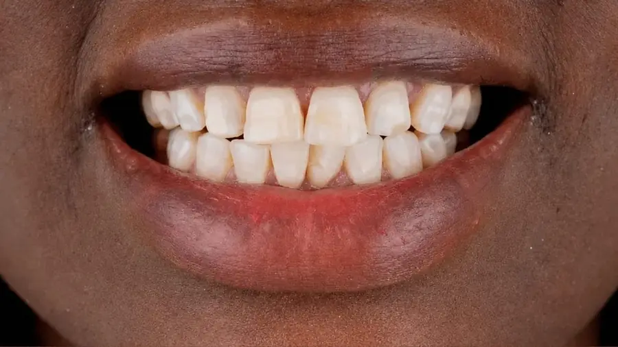 Before and after layered ceramic veneers at Esthetic Dent in Costa Rica — before