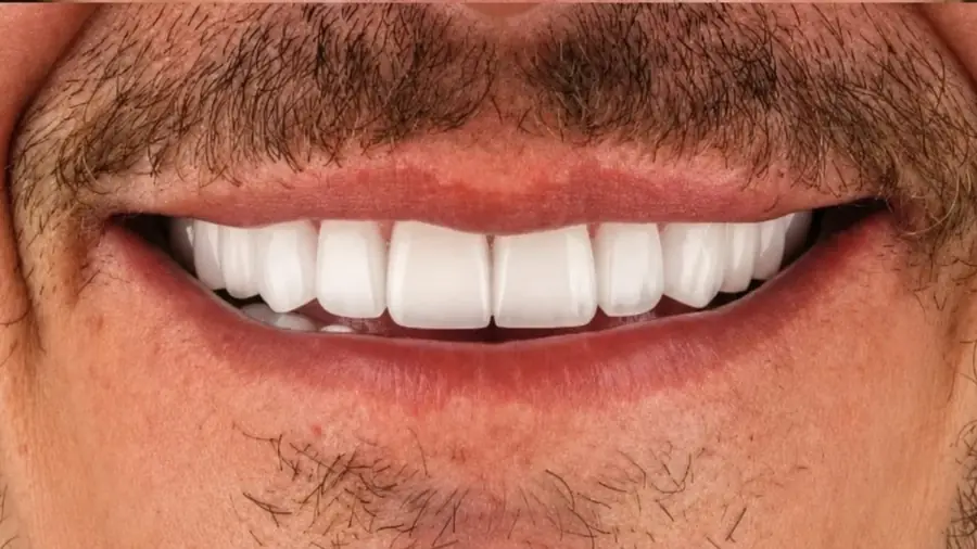 Before and after porcelain veneers at Esthetic Dent in Costa Rica — after